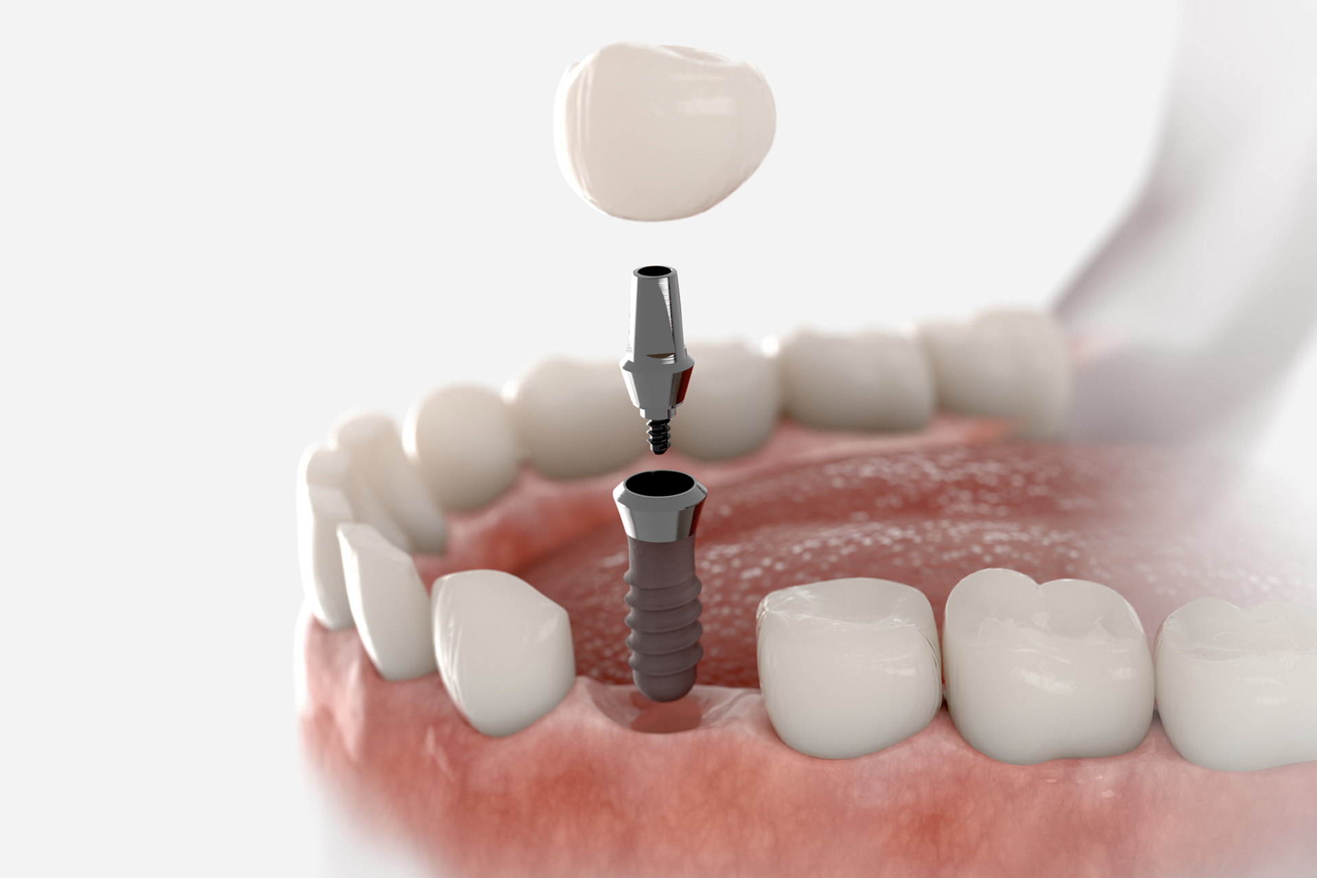 Implant Instantané