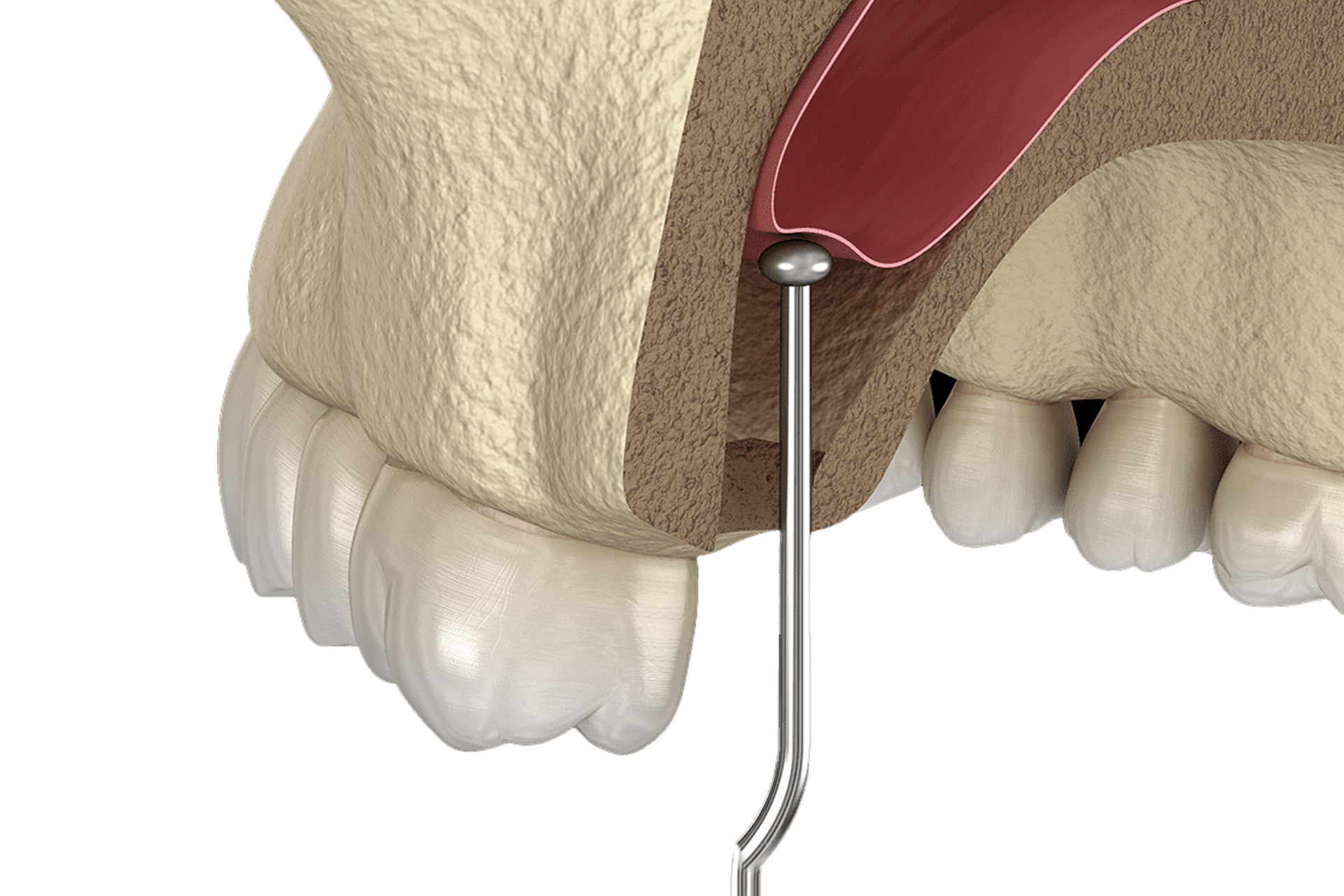 Le Lifting Du Sinus