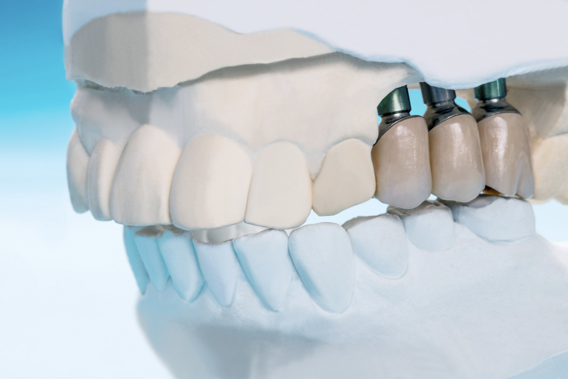 Multiple Teeth Implants